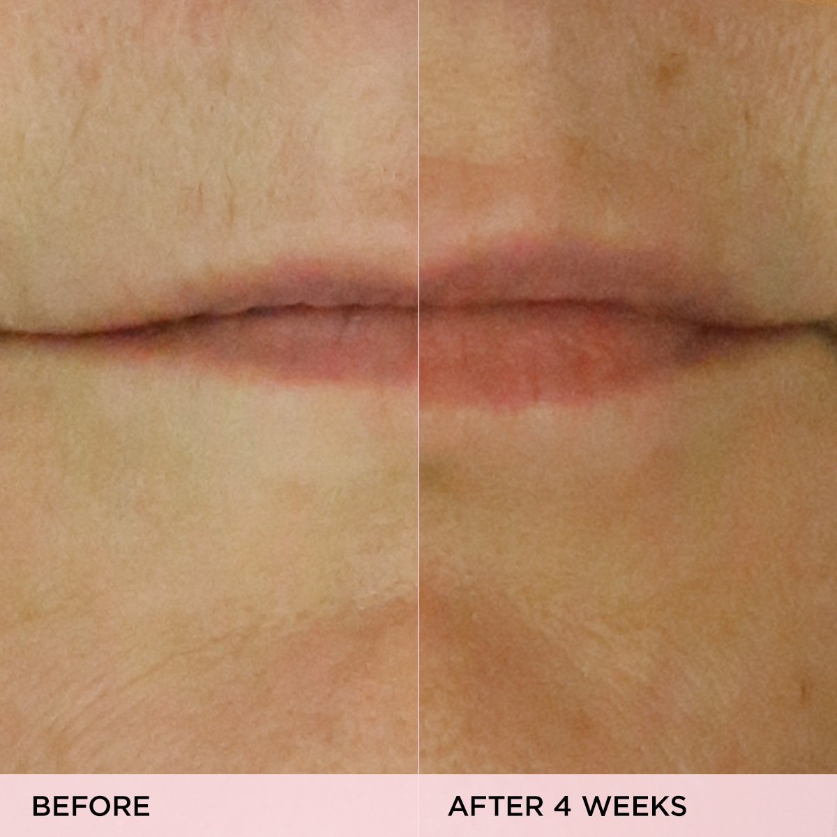 The Kissu Lip Treatment Moisture Support Lip Care for Everyday Use